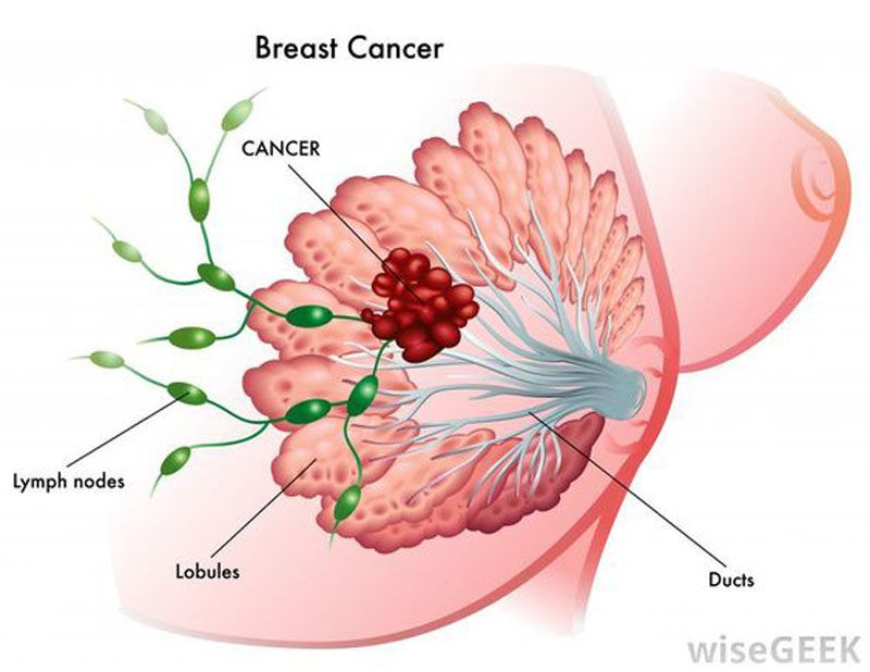 blv and breast cancer